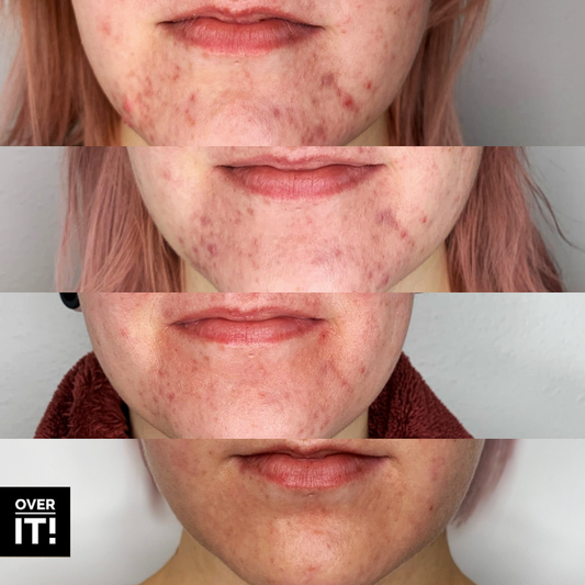 Dealing with Hormonal Acne?