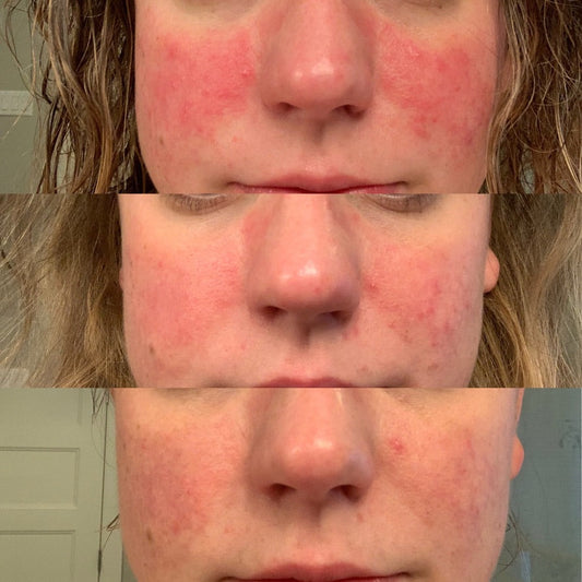 I had given up hope that I would ever be able to manage my rosacea.