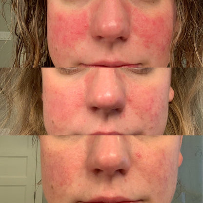 Acne Rosacea Routine